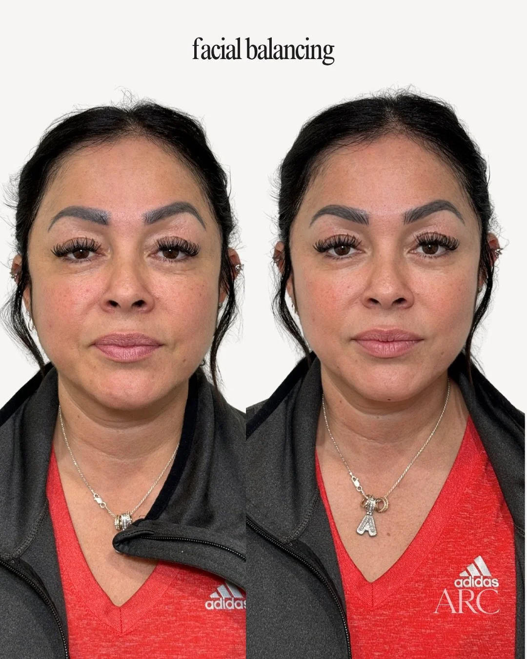 The best results aren&rsquo;t obvious. Undetectable but impactful results are my speciality. 🪞🖤

ARC Aesthetics | booking link in bio 

#omahabotox #omahafacialbalancing #omahachinfiller #omahajawfiller