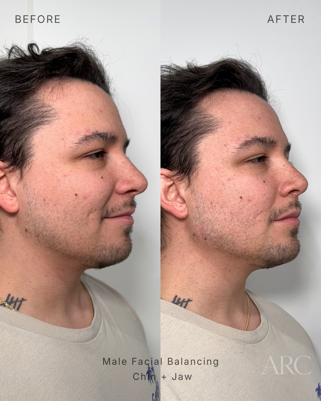 Male Facial Balancing