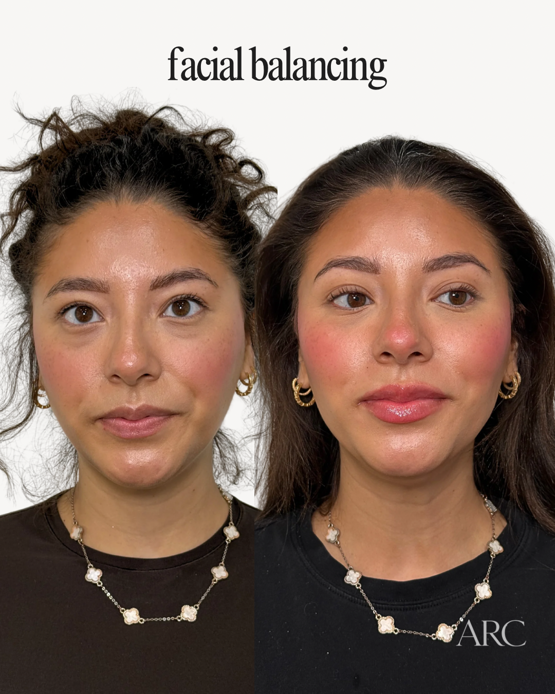 Facial Balancing