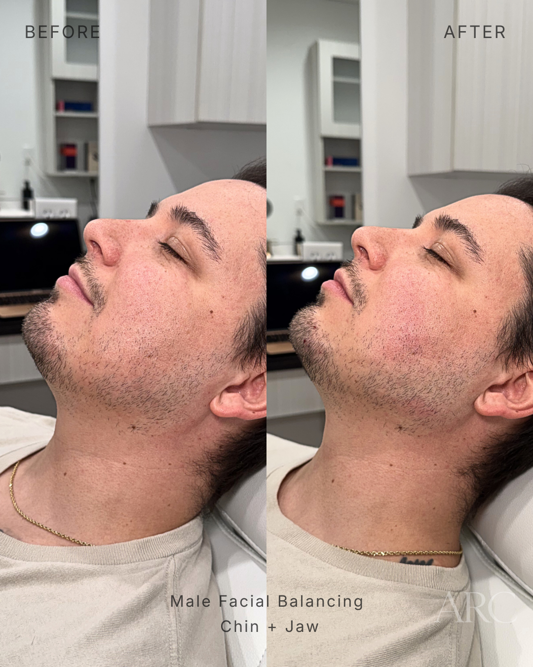 Male Facial Balancing