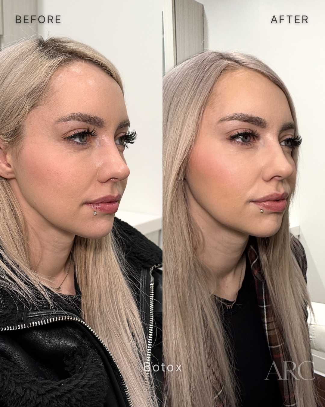 Botox - Lower Face