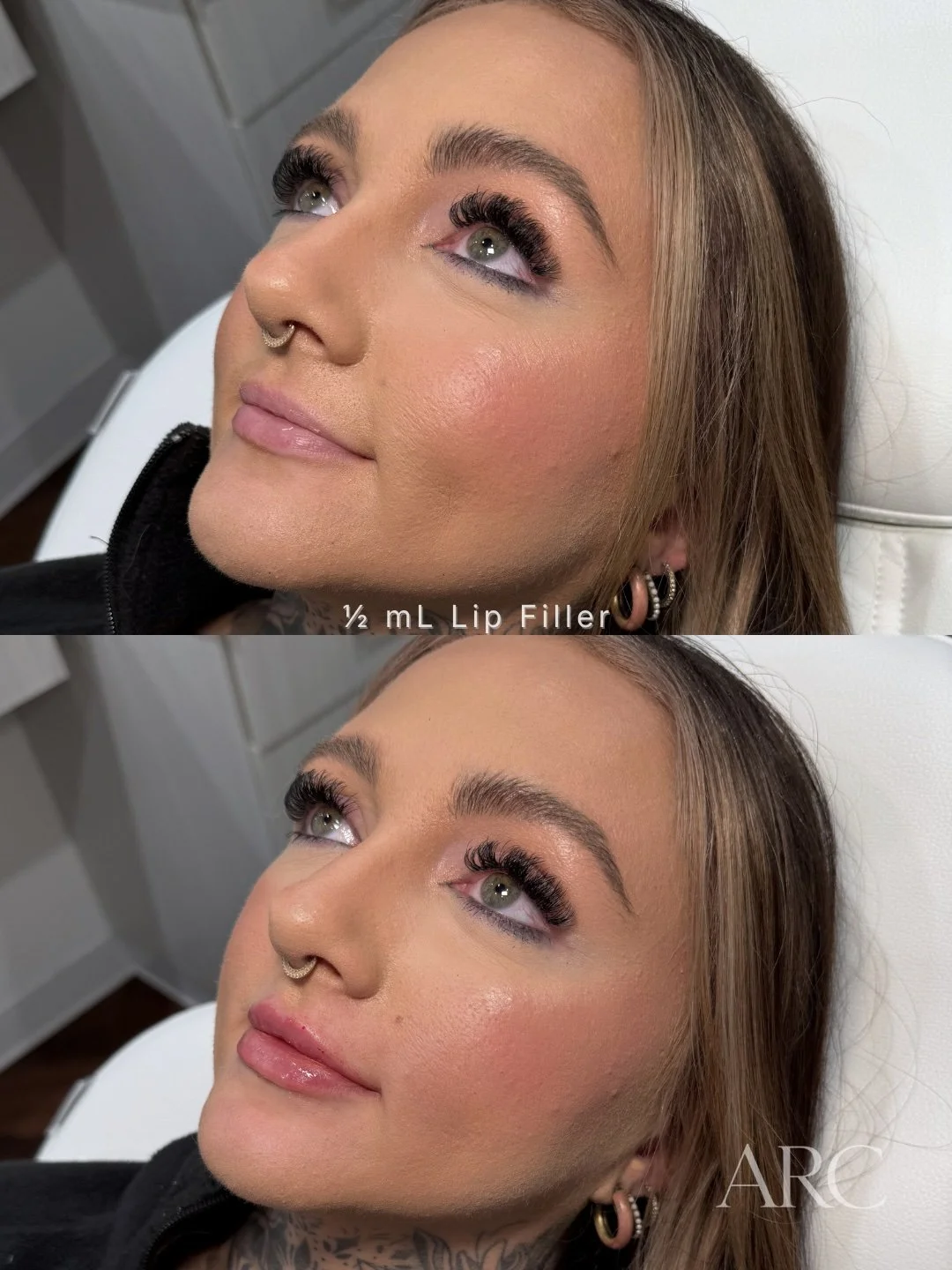1/2 mL Lip Filler