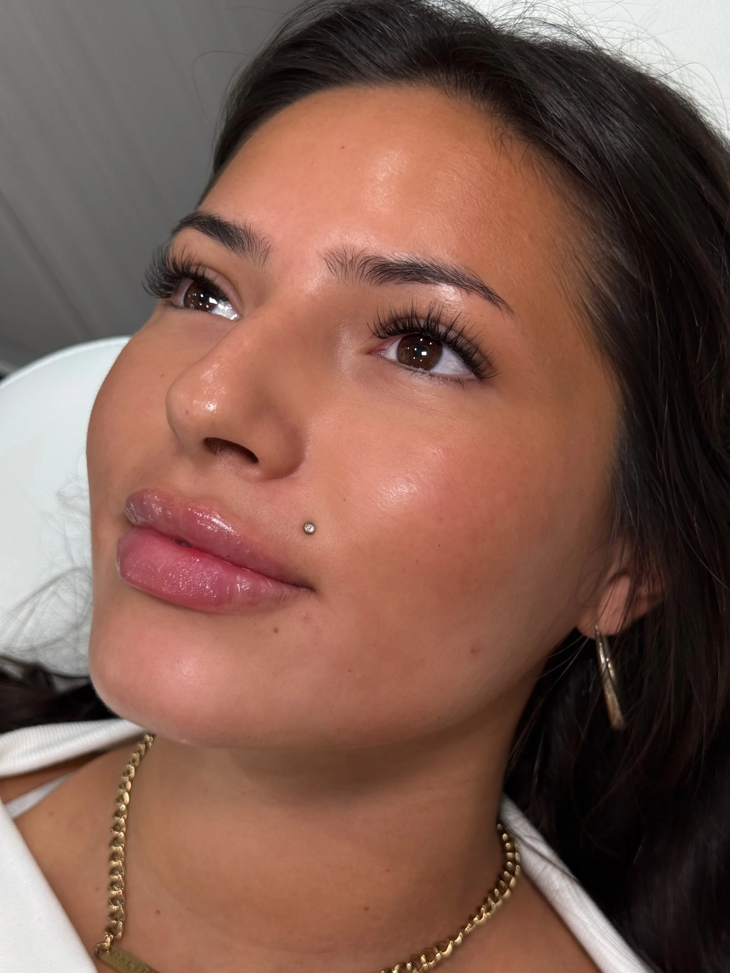 1 mL Lip Filler