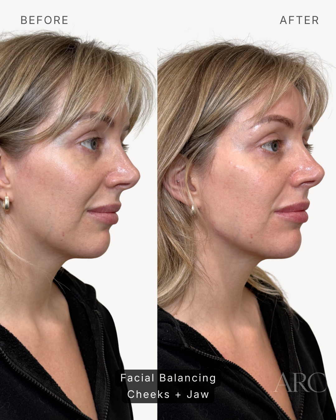 Facial Balancing
