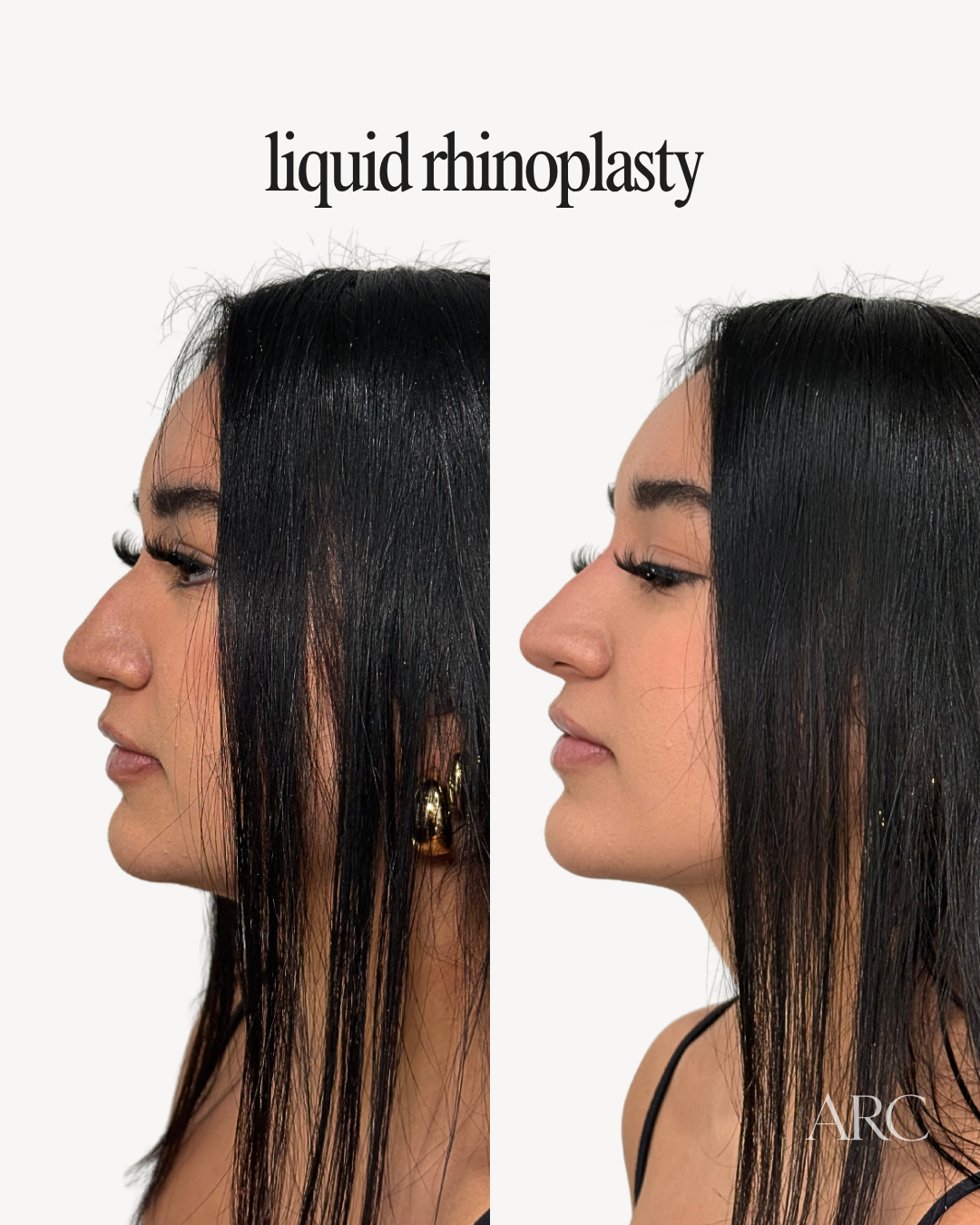 Liquid Rhinoplasty