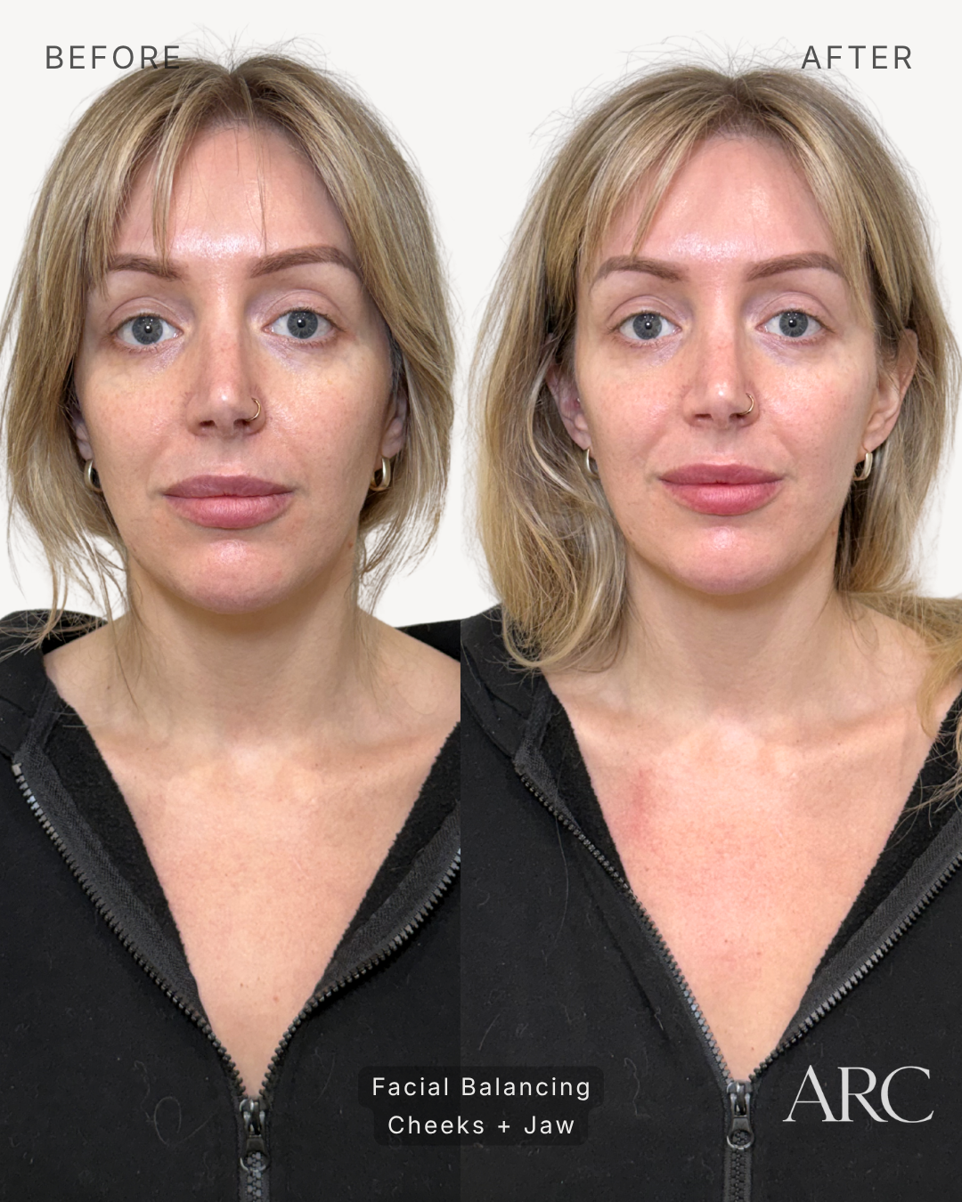Facial Balancing