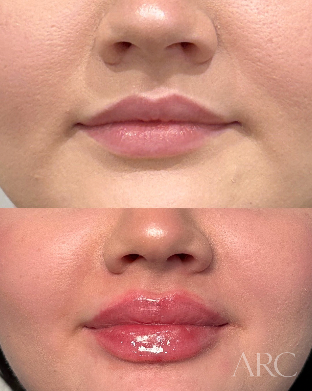 1 mL Lip Filler