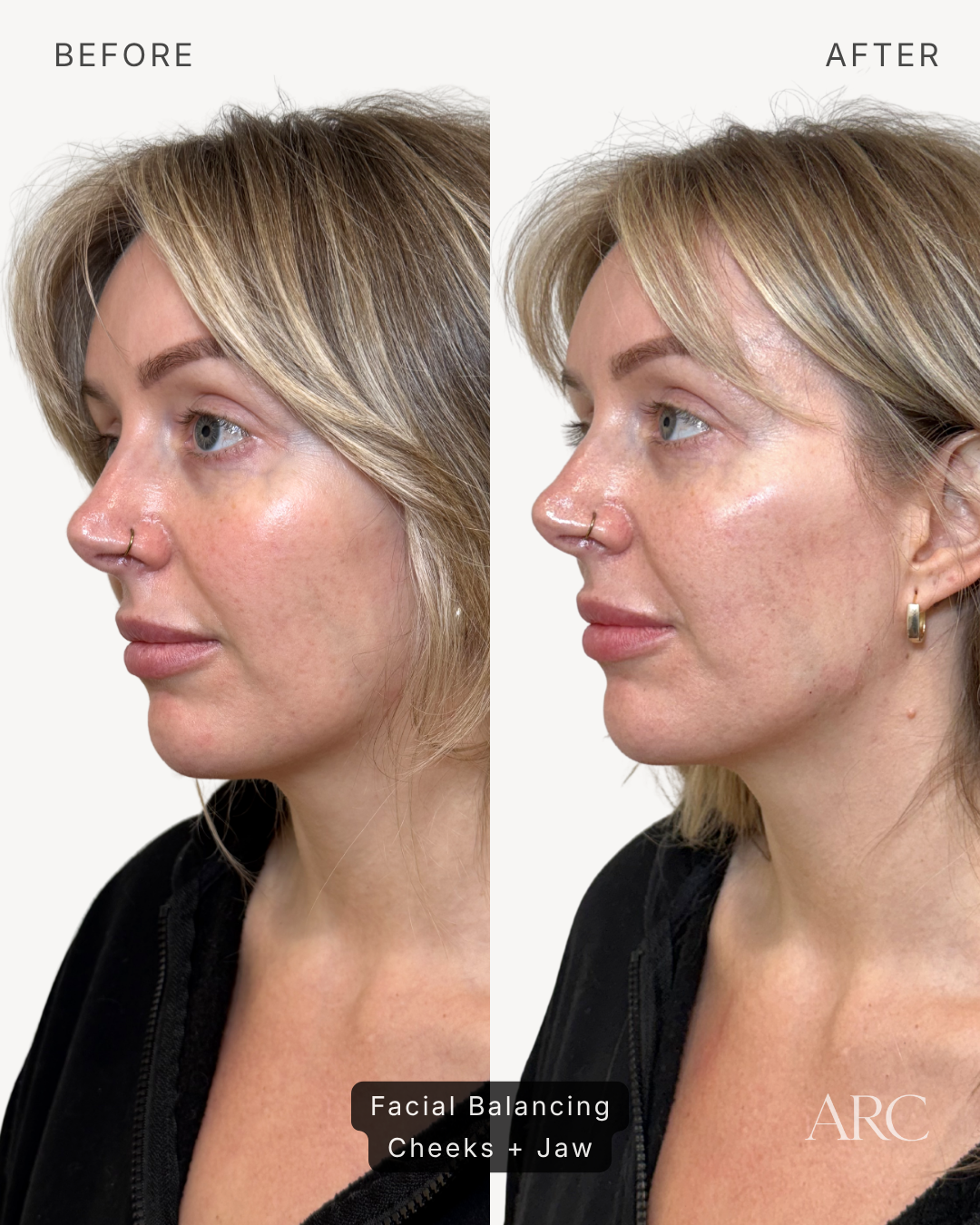 Facial Balancing