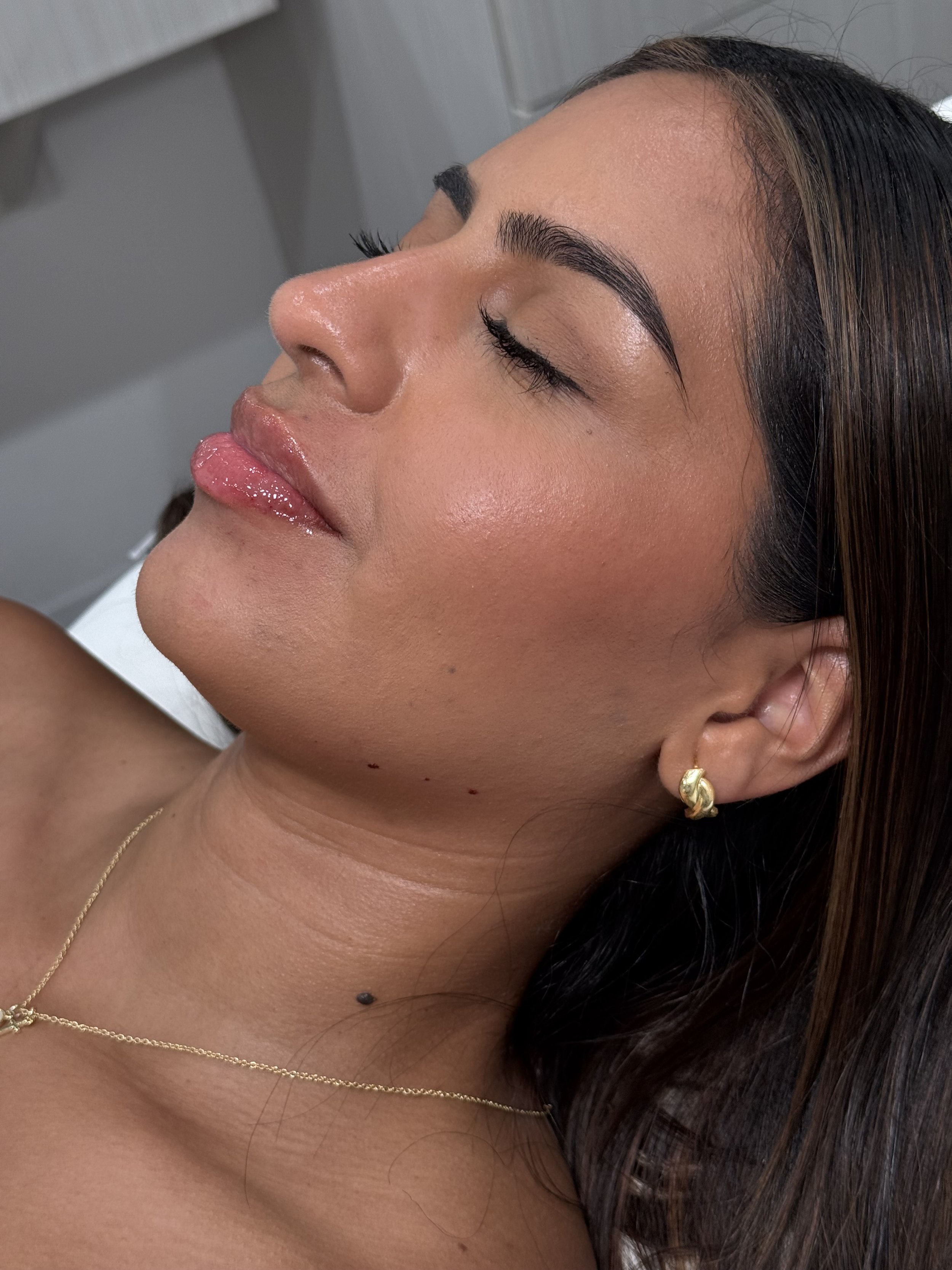 1 mL Lip Filler