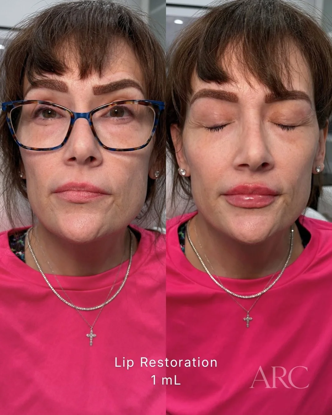 1 mL Lip Filler