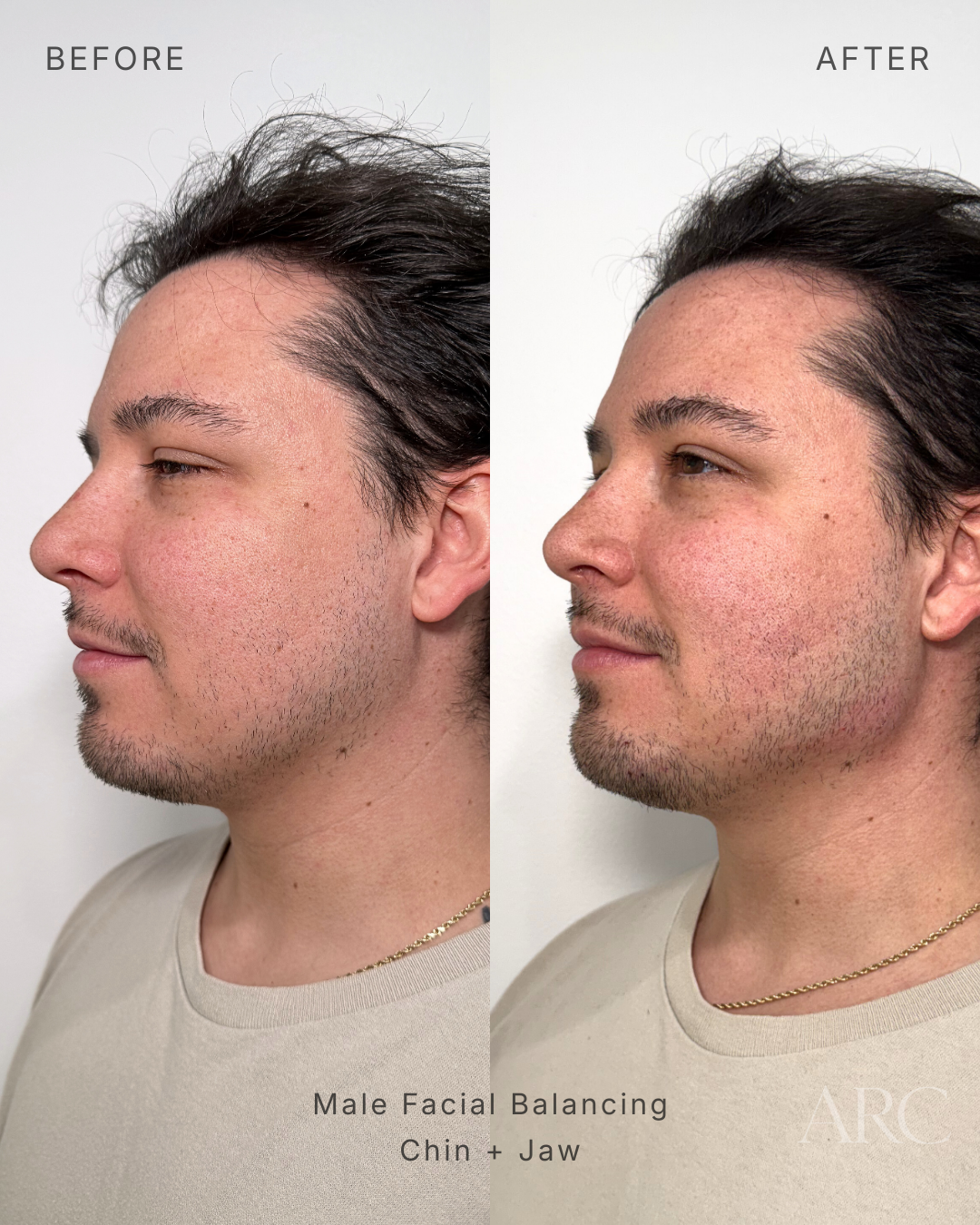 Male Facial Balancing