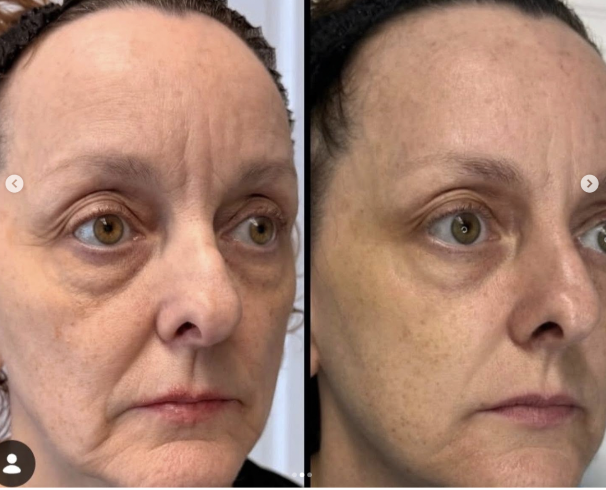 Jet Plasma before and after