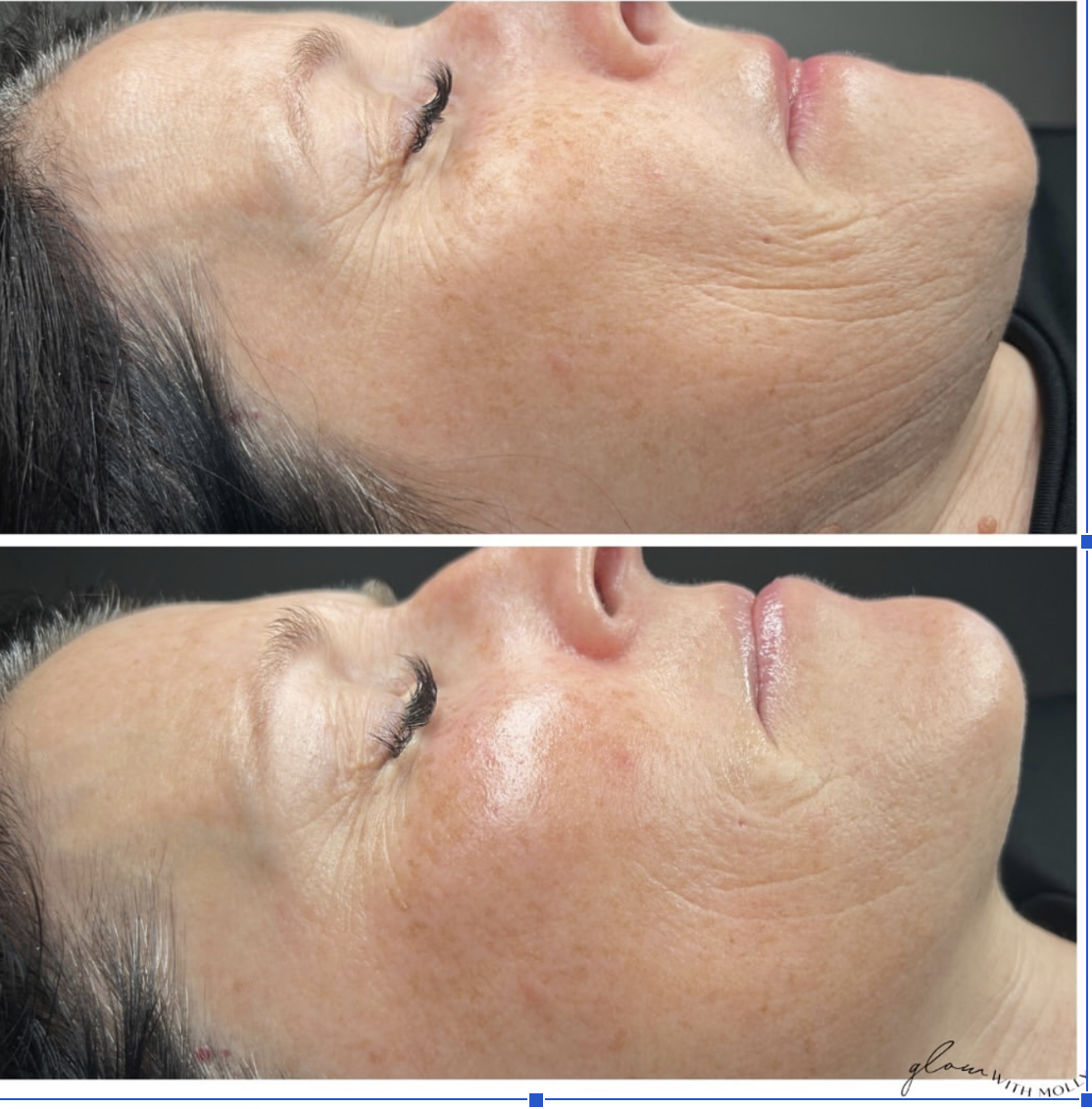 Jet Plasma before and after