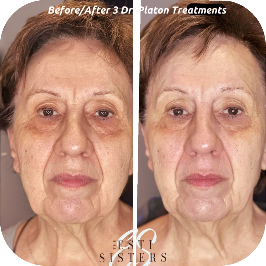Side-by-side comparison of an elderly woman's face before and after three Dr. Platon treatments, showing reduced under-eye bags, wrinkles, and a more youthful appearance.