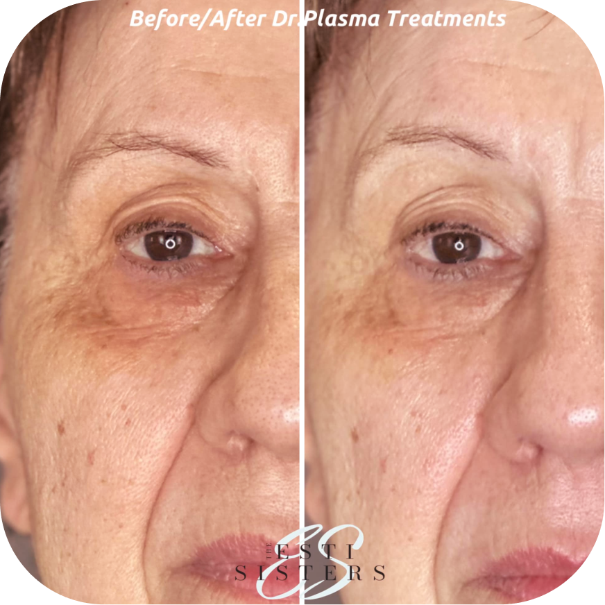 Close-up of a woman's face showing the area around her eye, comparing before and after plasma treatments. The before side shows more wrinkles and sagging, while the after side shows smoother skin. Text indicates it's a side-by-side comparison of plasma treatments.