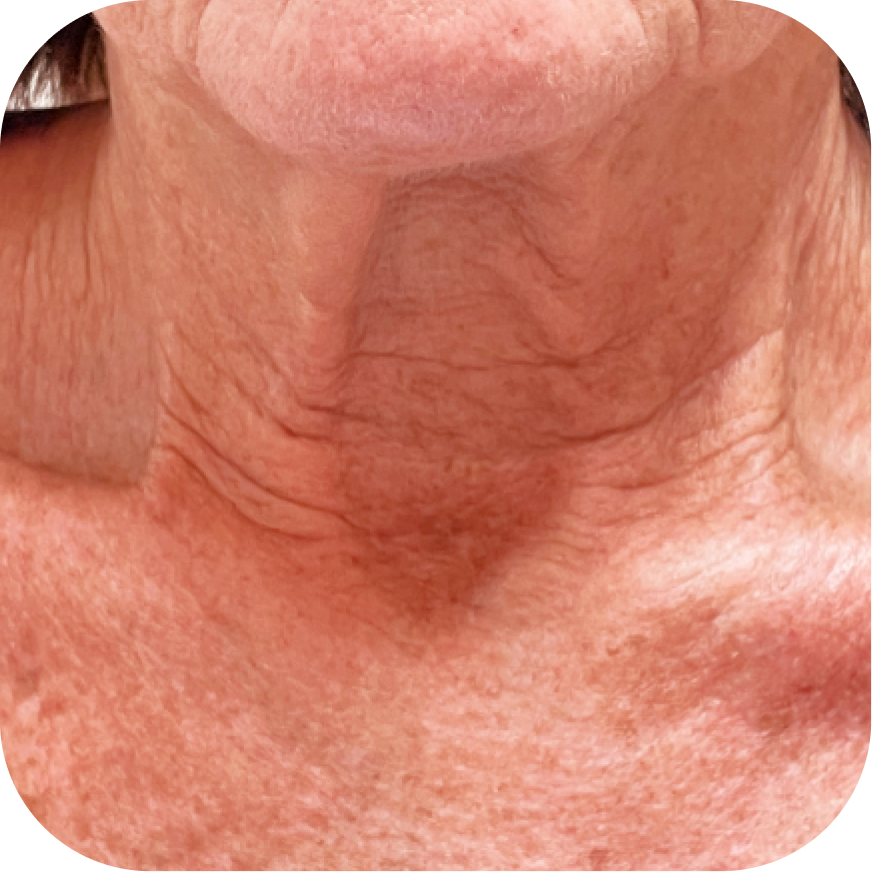 Close-up image of an older person's neck showing skin with wrinkles and age spots.