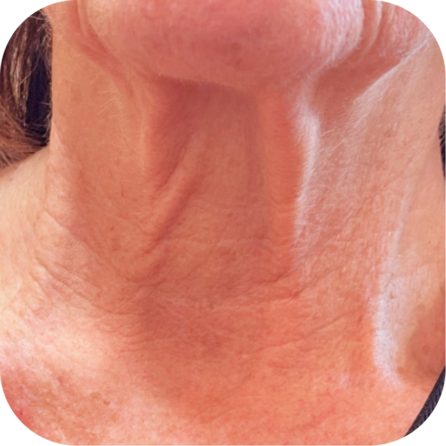 Close-up of a person's neck with visible skin texture and wrinkles.