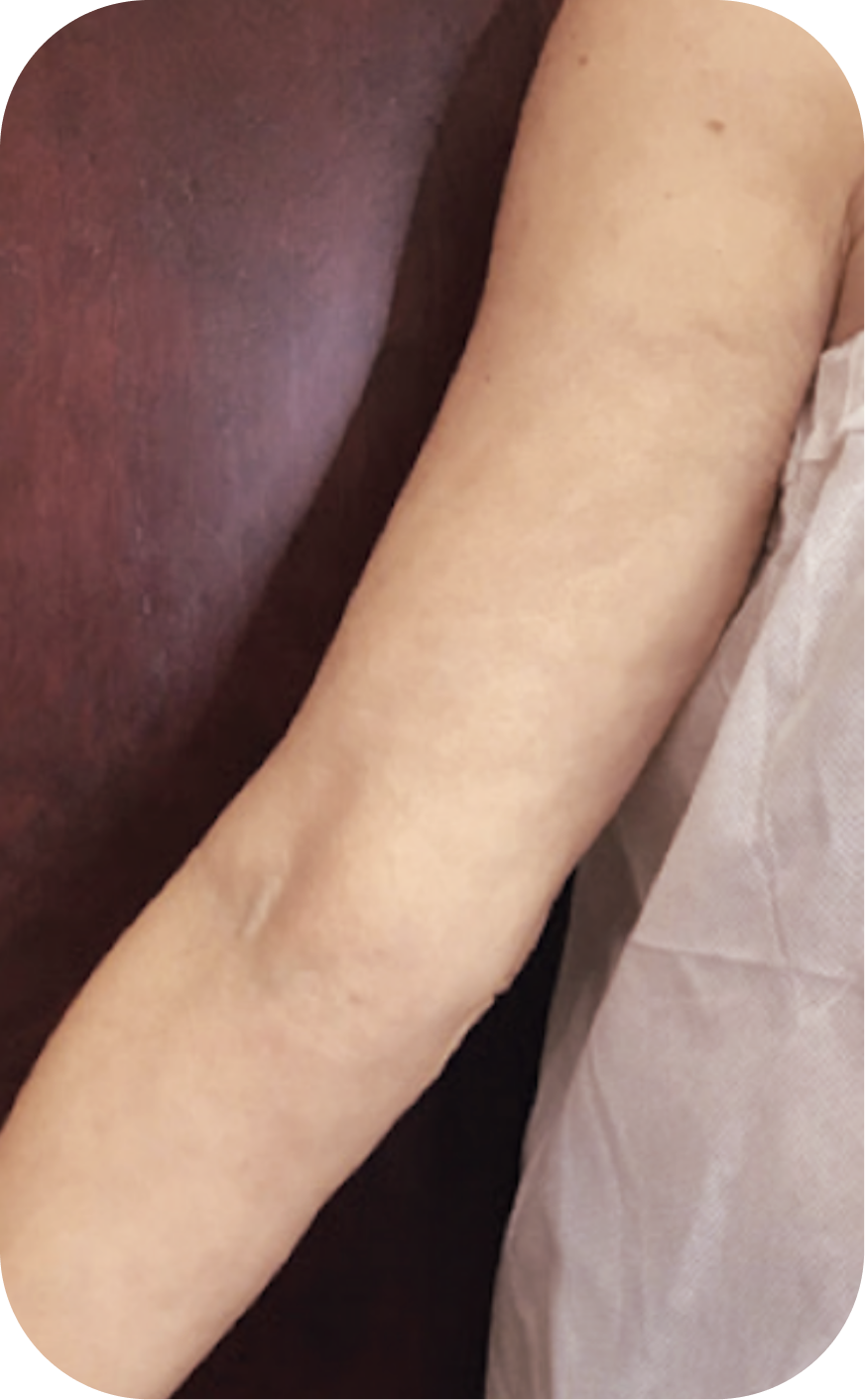 Close-up of a person's arm resting against a dark brown surface, with part of a white cloth visible.