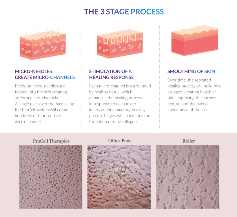 Diagram illustrating three stages of a skin healing process: micro-needles create micro-channels, stimulation of healing response with tissue around micro-channels, and smoothing of skin over time, alongside microscopic images of ProCell therapies, other pens, and a roller.