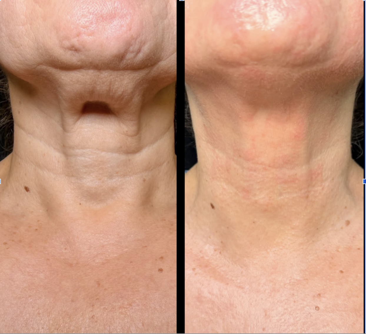Jet Plasma before and after