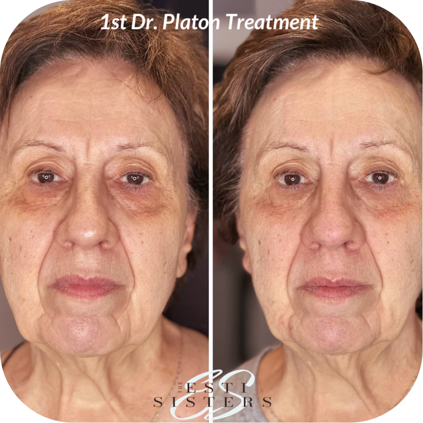 Side-by-side comparison of a woman before and after her first Dr. Plathom treatment, showing improved skin appearance with reduced wrinkles and dark circles under the eyes.