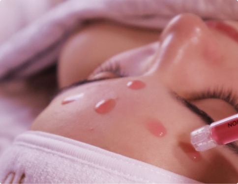 Close-up of a person's face with multiple red spots being treated with a syringe.