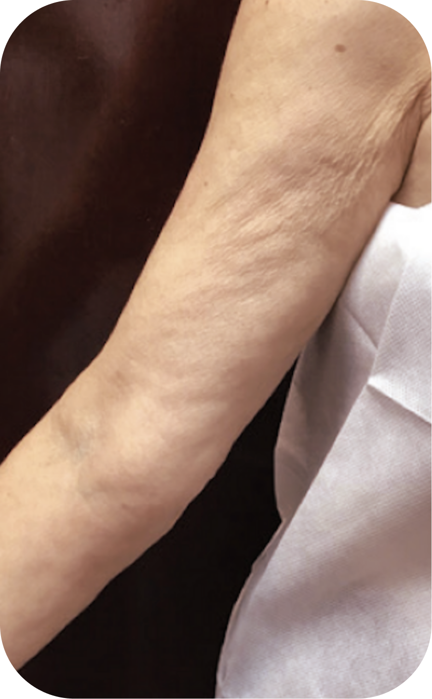 Close-up of an elderly person's arm with visible skin texture and wrinkles, resting on white clothing.