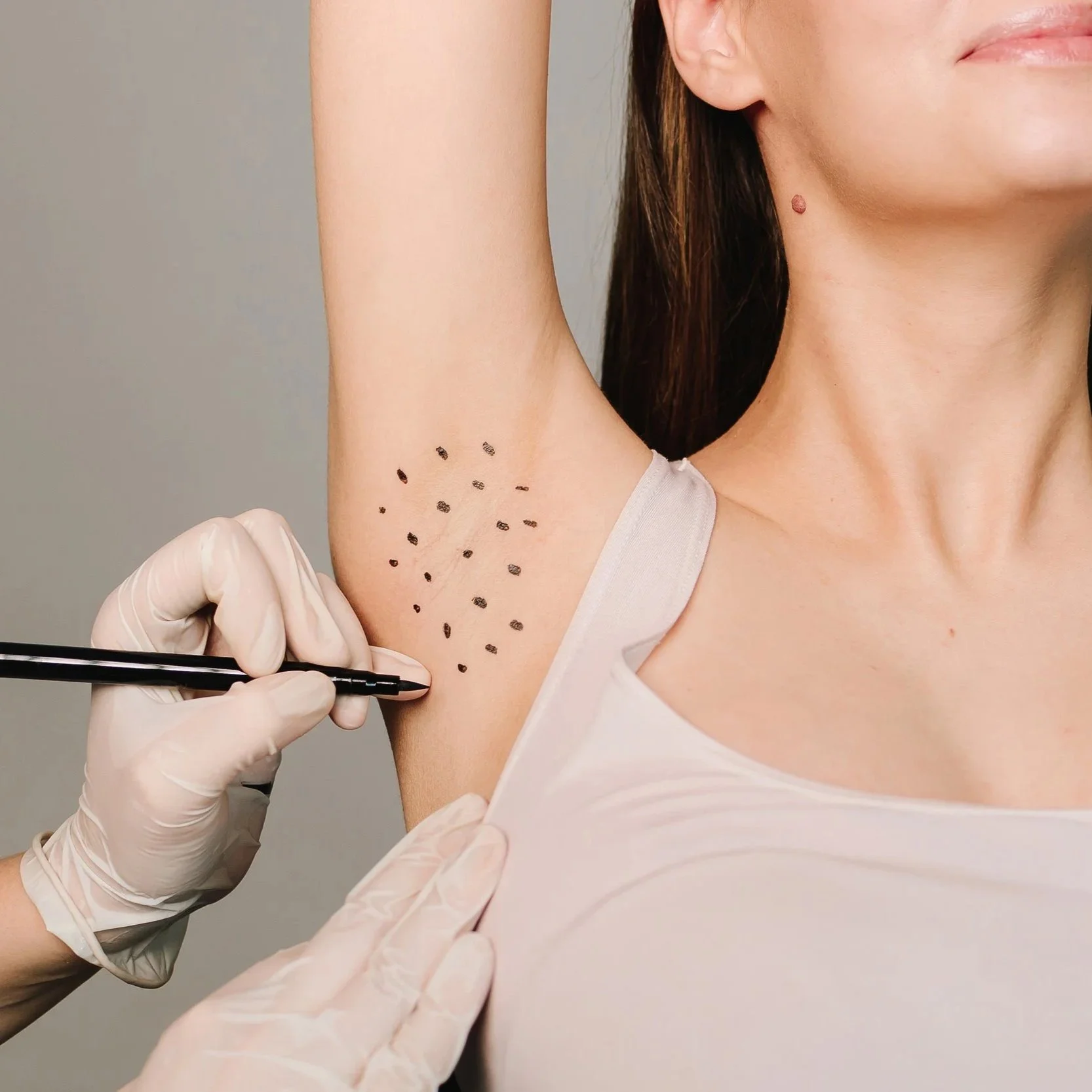 Treating Excessive Sweating with Botulinum Toxin — A Highly Effective Solution for Axillary Hyperhidrosis at our Surrey Clinic