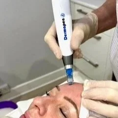 Microneedling — What It Is, How It Works, and Why It Still Has a Place