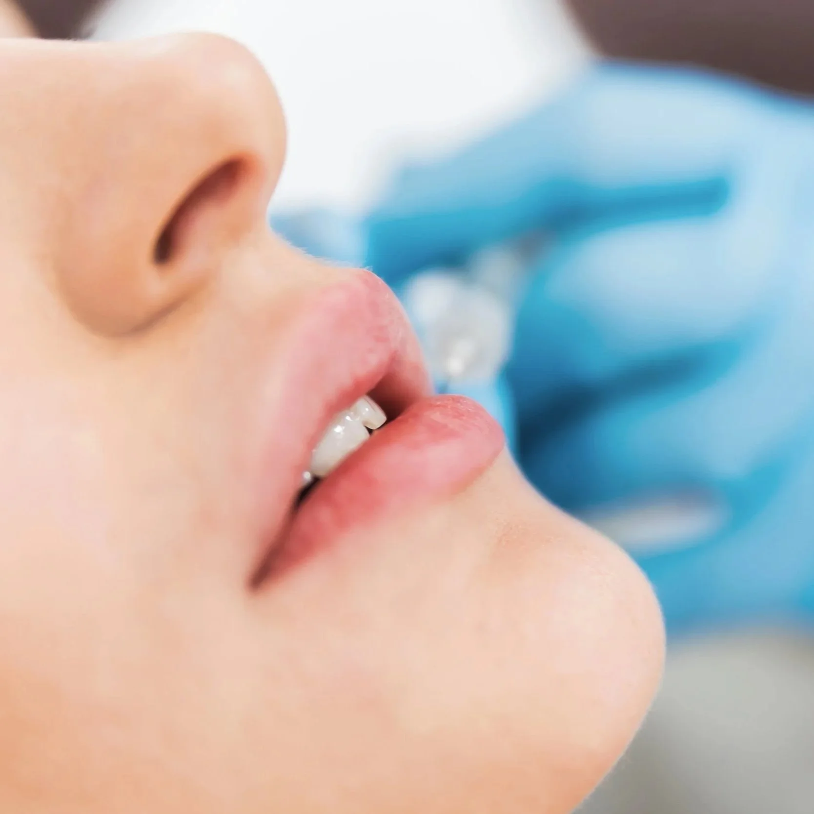 What is the difference between Profhilo and Dermal Fillers?