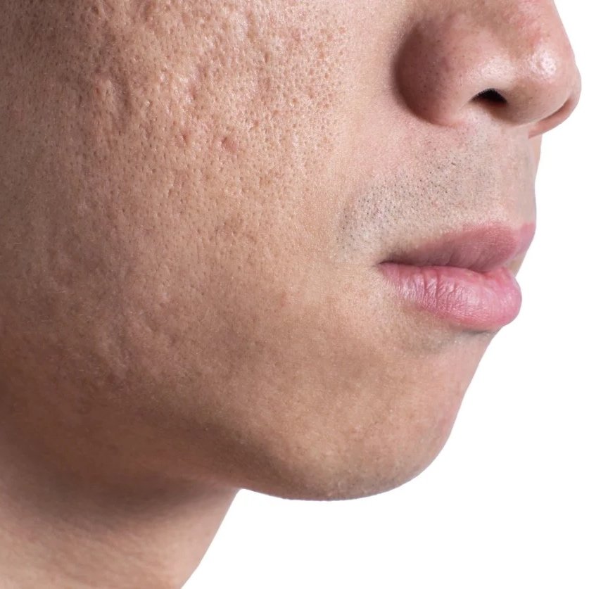 Treatment of Post-Acne Facial Scarring