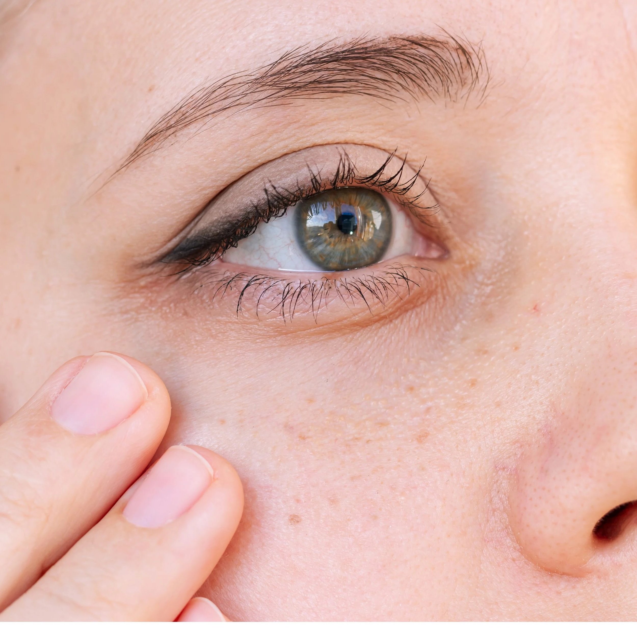 Are Polynucleotides Any Good for the Under-Eye Area?