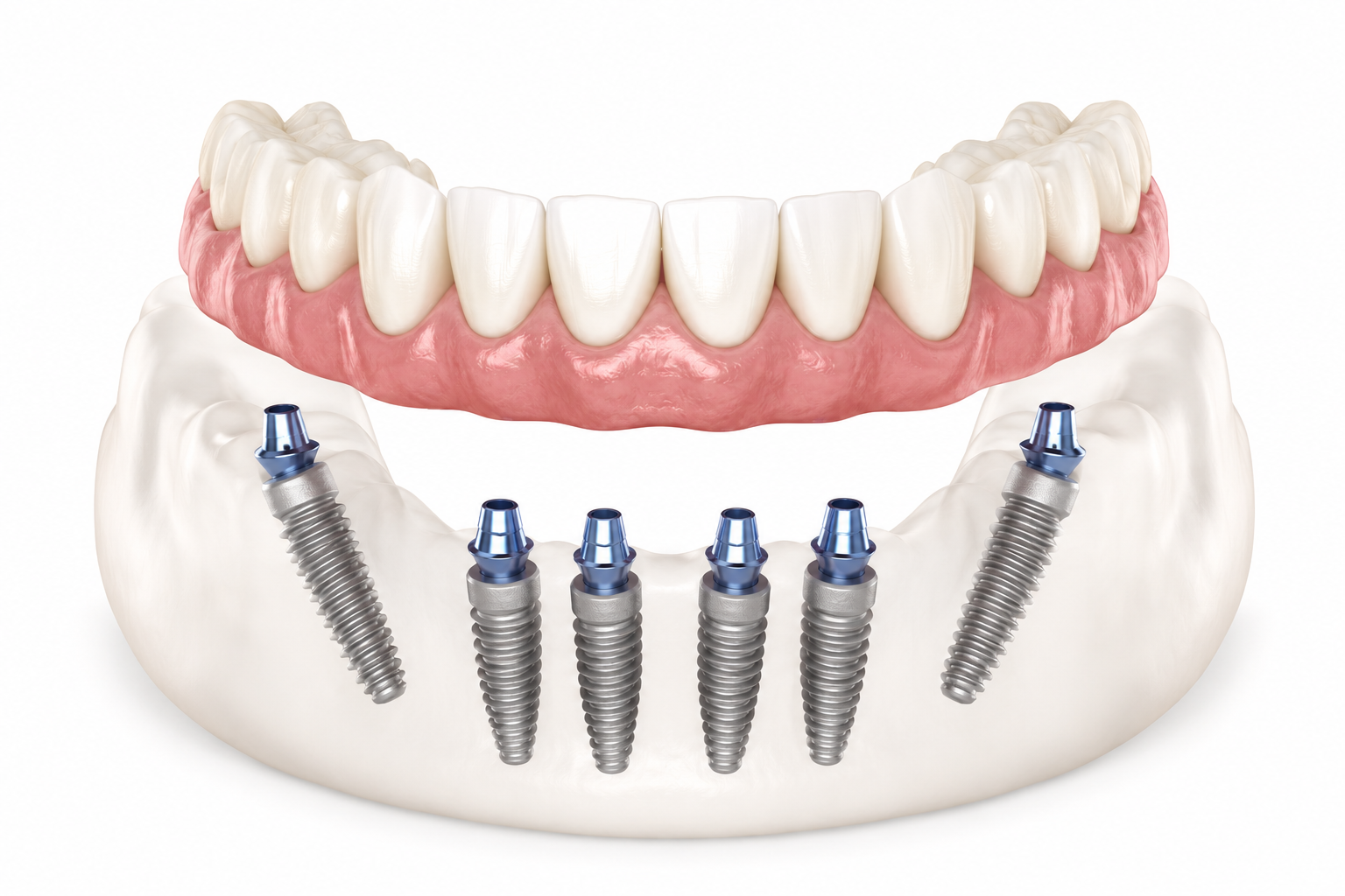 3D illustration of an All-on-6 full-arch restoration supported by six dental implants