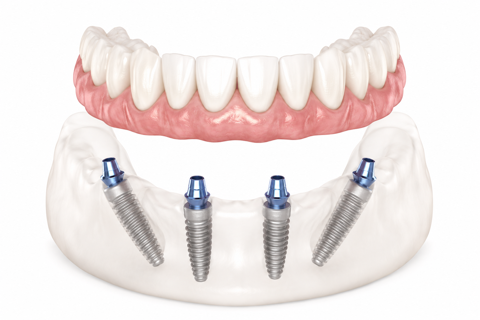 All-on-4 dental implant restoration showing a full-arch prosthesis supported by four implants