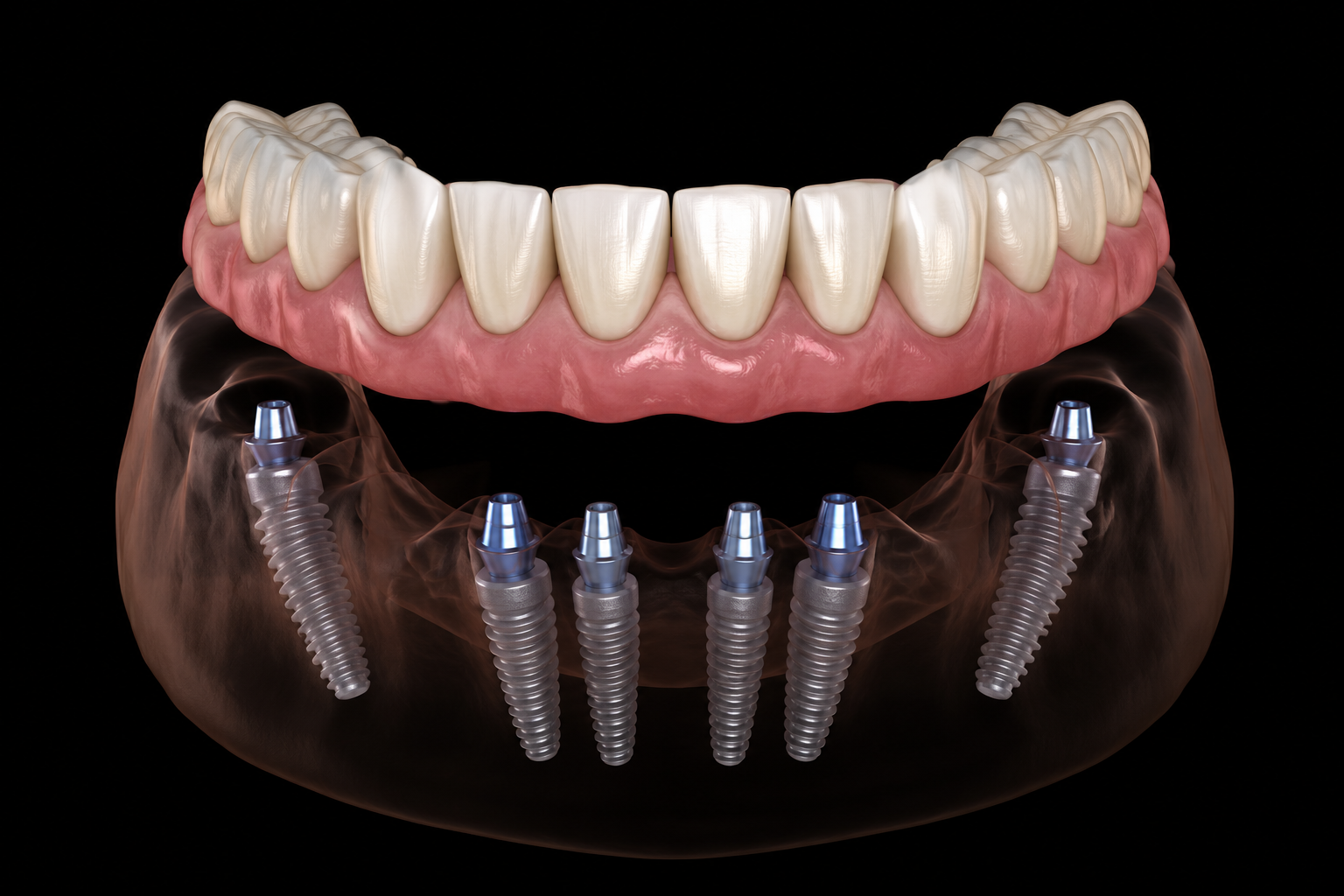3D illustration of an All-on-6 dental implant bridge supported by six implants