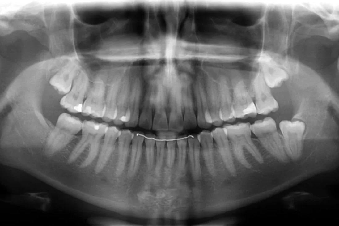 X-ray image of a human mouth showing teeth, jawbone, and nasal cavity.