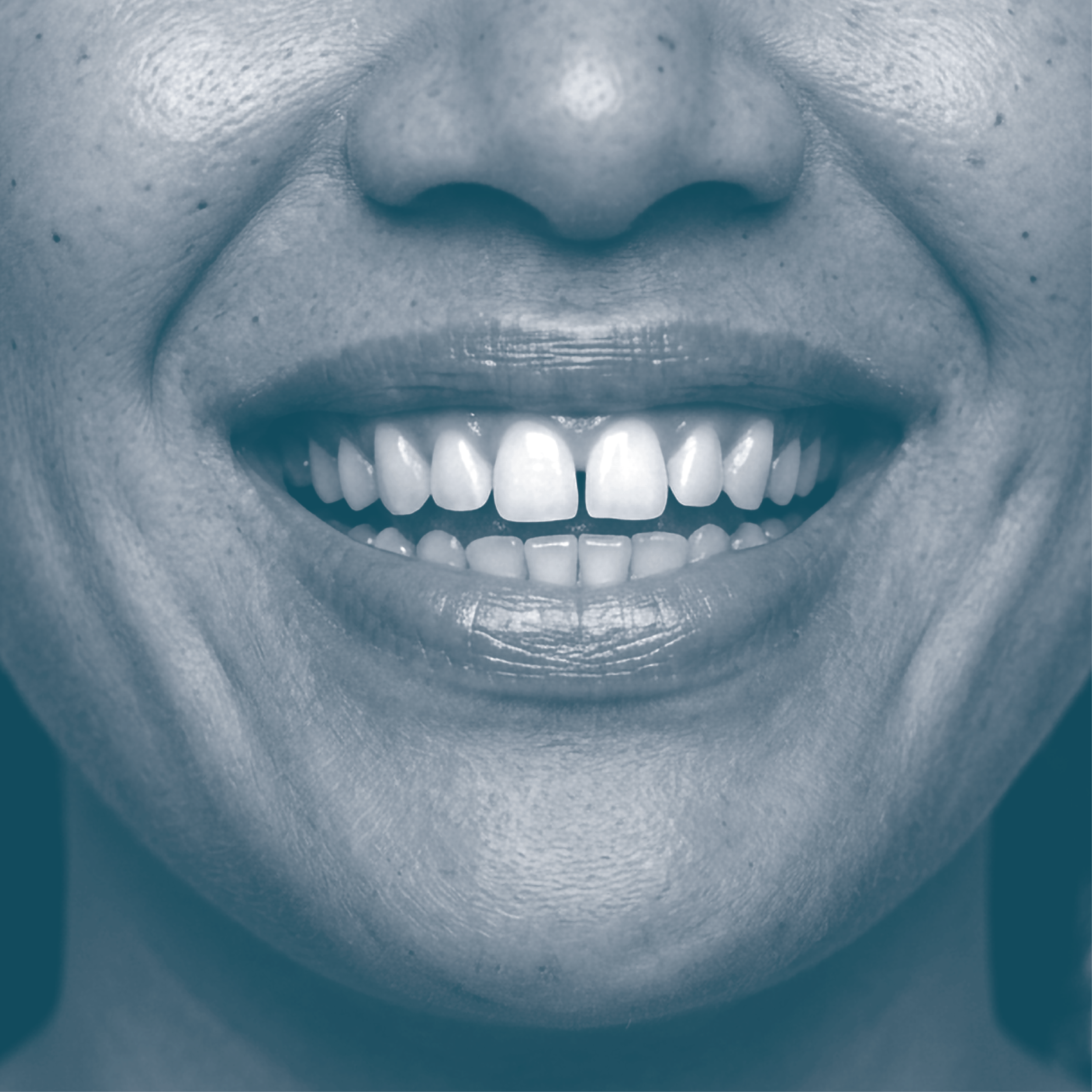 Close-up of a smiling person's mouth with missing and crooked teeth.