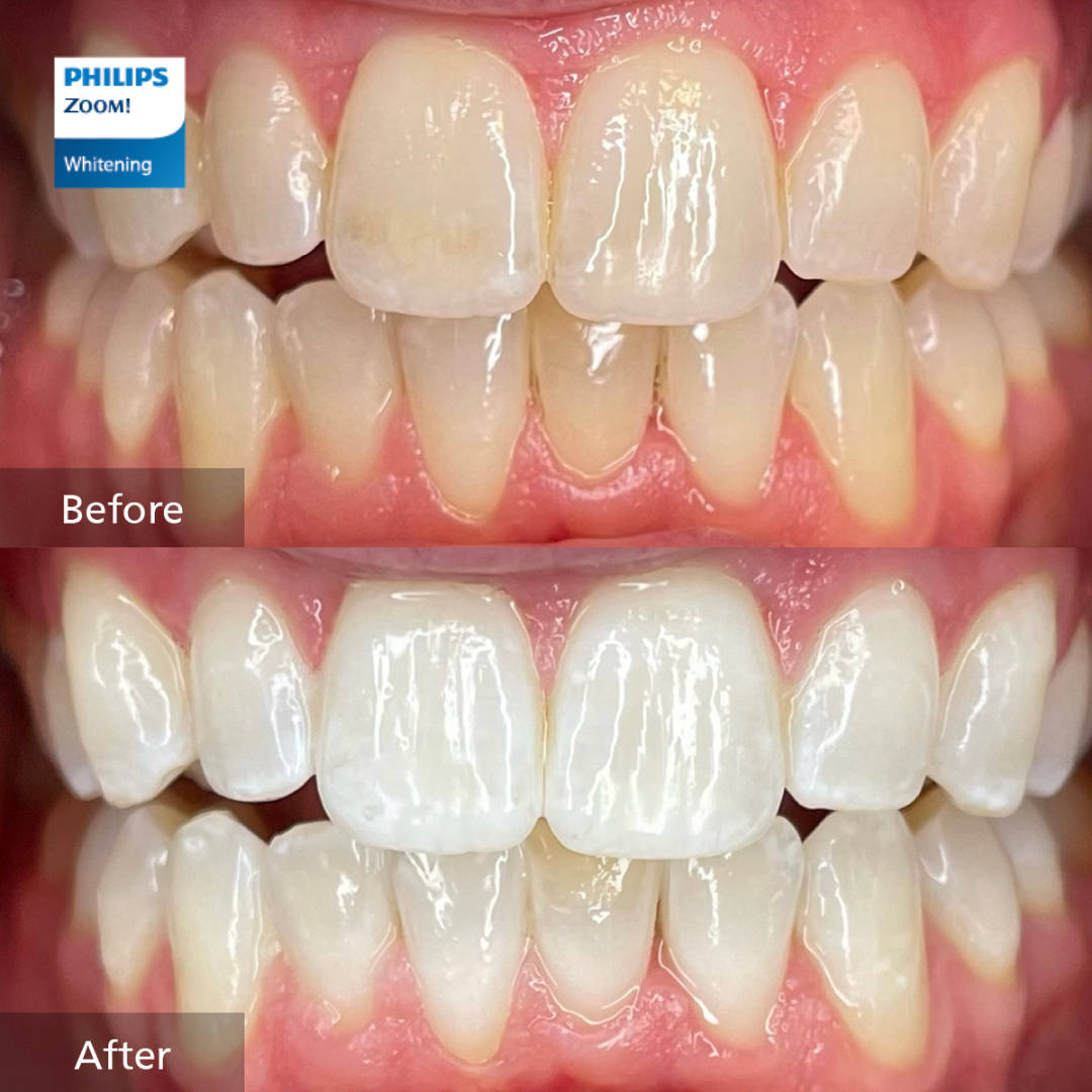 Close-up view of teeth showing before and after teeth whitening results. The "before" image displays teeth with stains and discoloration, while the "after" image shows noticeably whiter teeth.