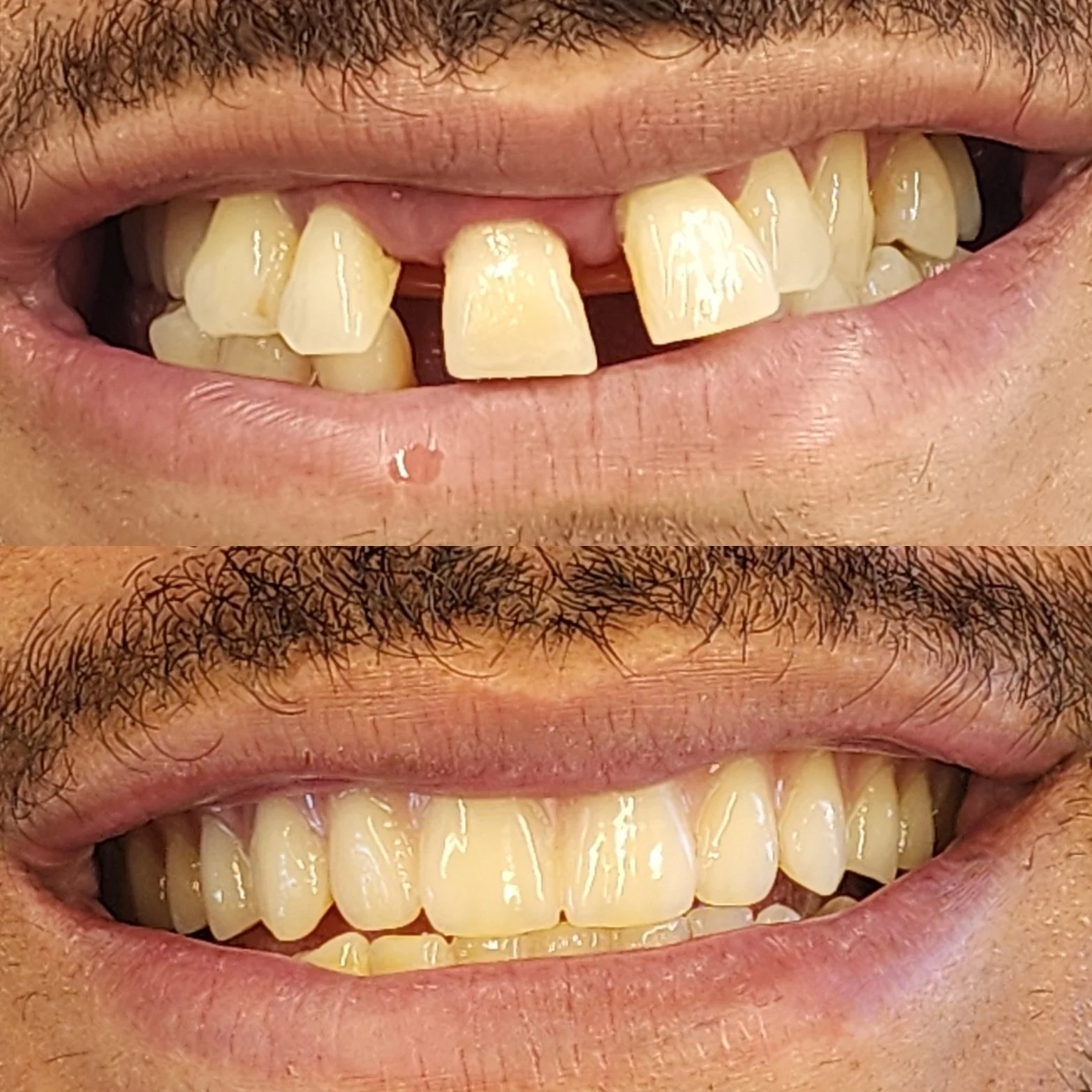 Comparison of a person's teeth before and after denture treatment. The top image shows teeth with discoloration and uneven appearance. The bottom image shows teeth that are brighter and more uniform.