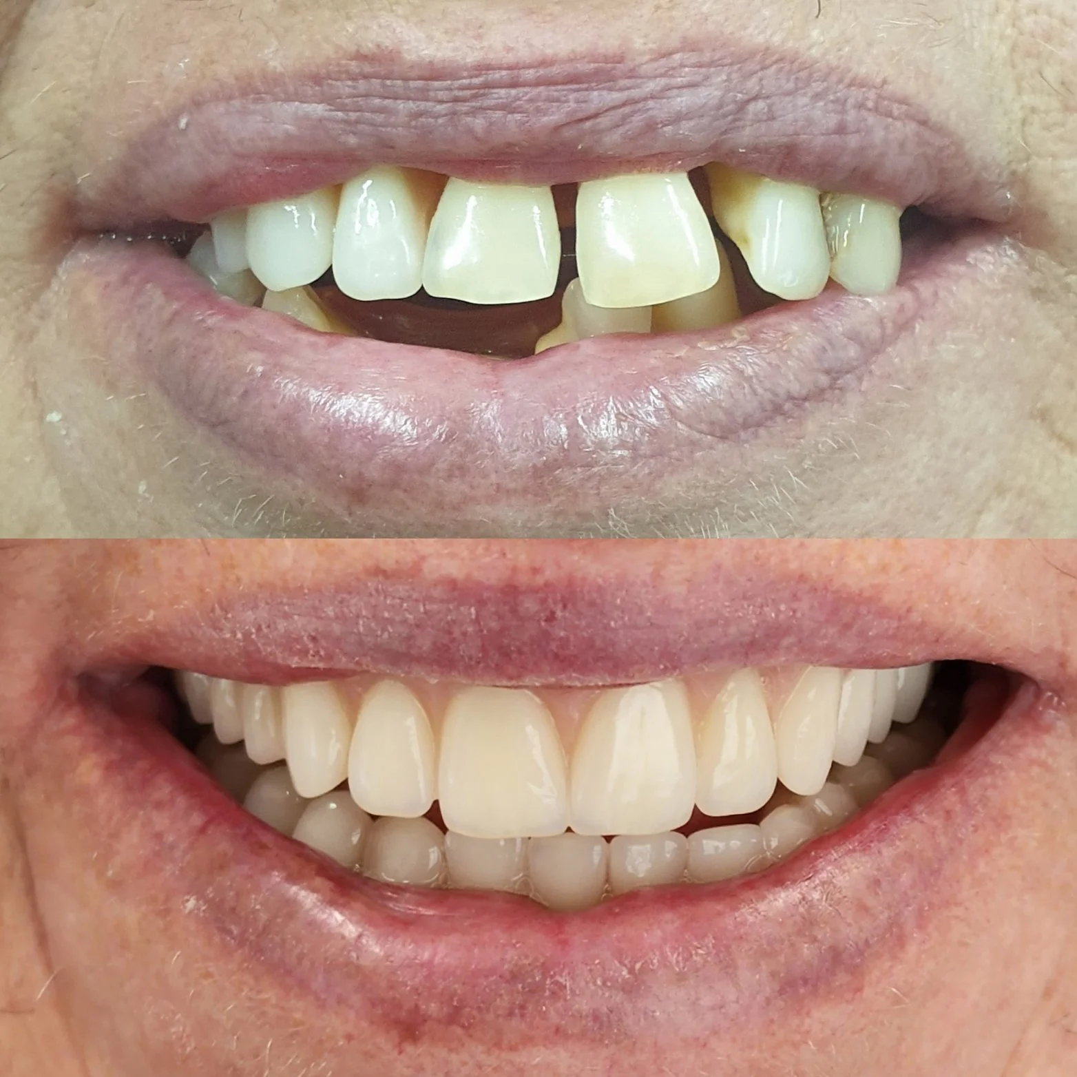 Close-up comparison of teeth before and after denture treatment, showing improved alignment and appearance.