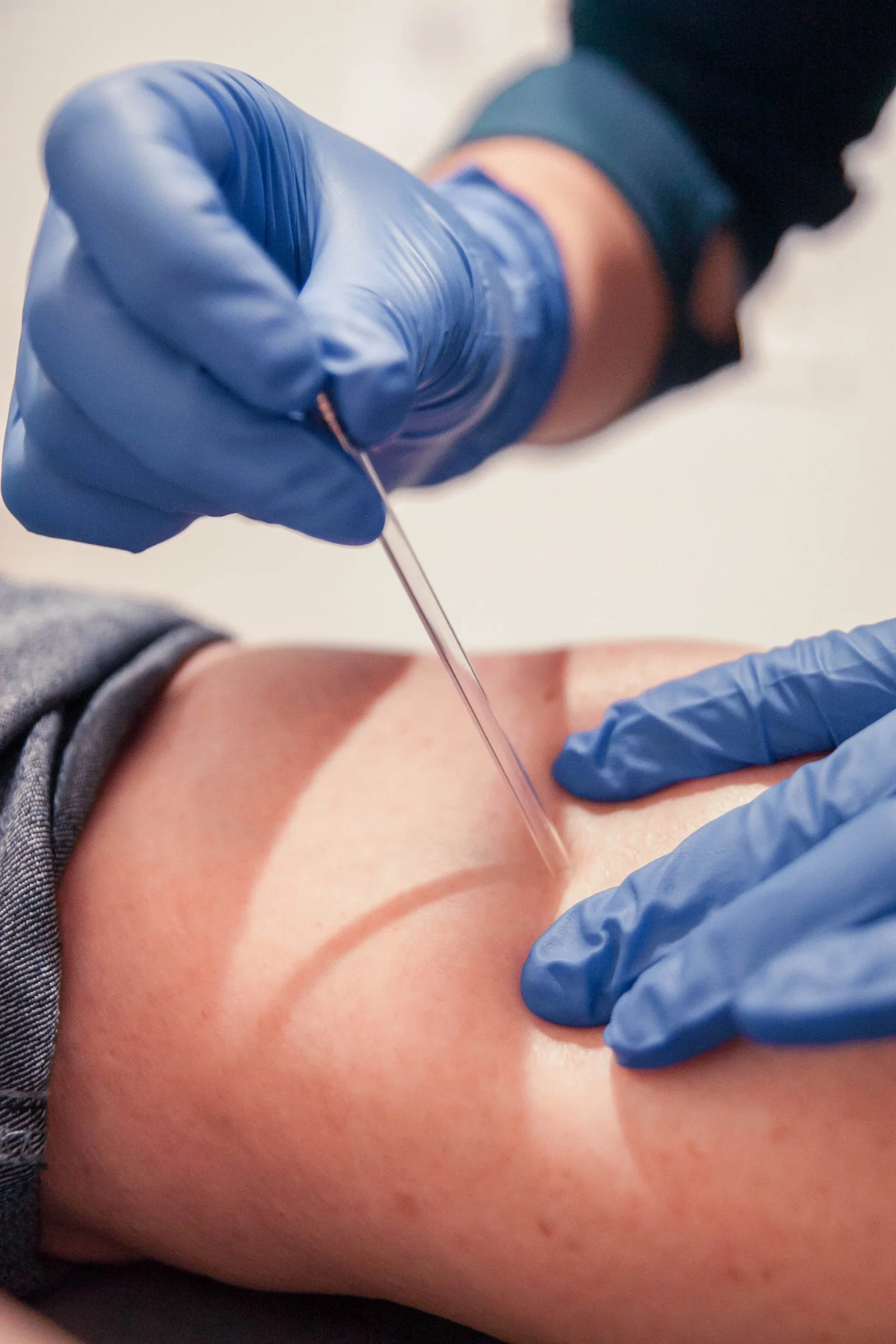 A person wearing blue gloves performing functional dry needling (FDN).