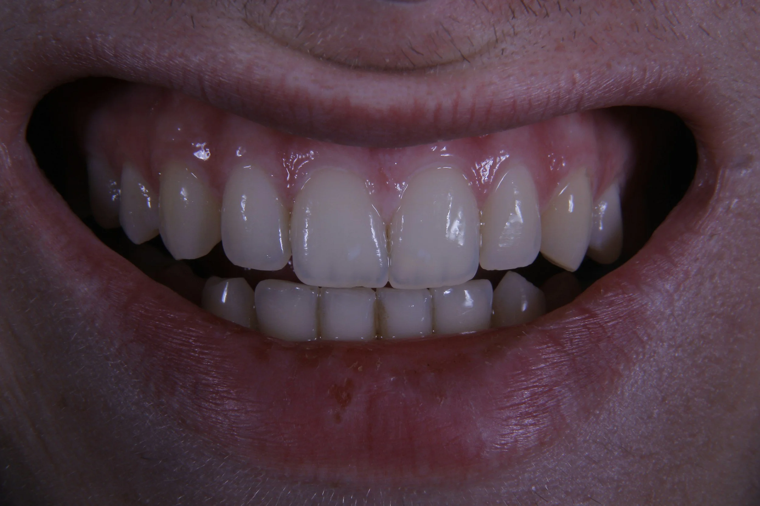 Close-up of a smiling person's mouth showing upper and lower teeth.
