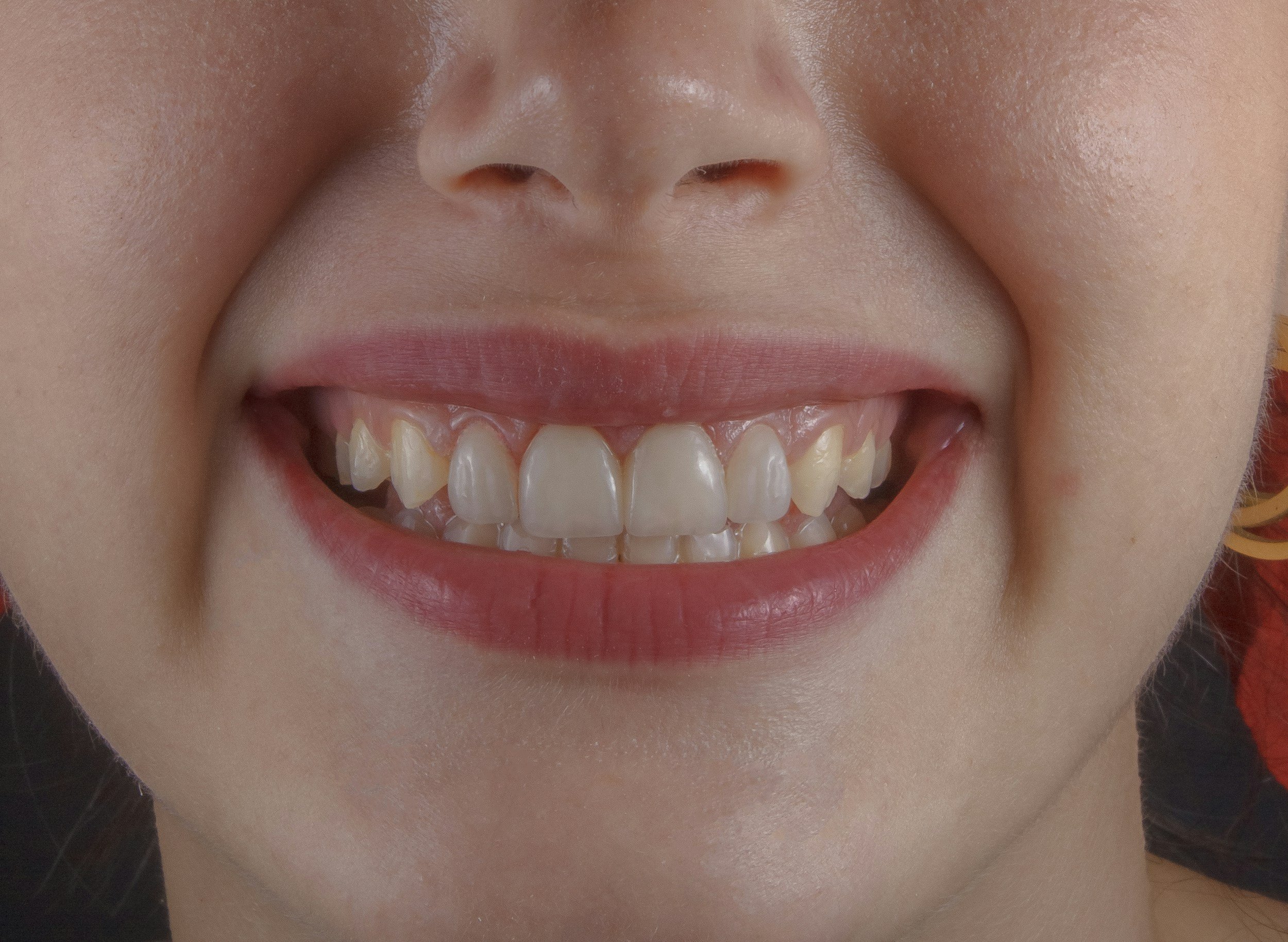 Why Does My Gum Bleed? Causes, Treatment, and When to See a Dentist
