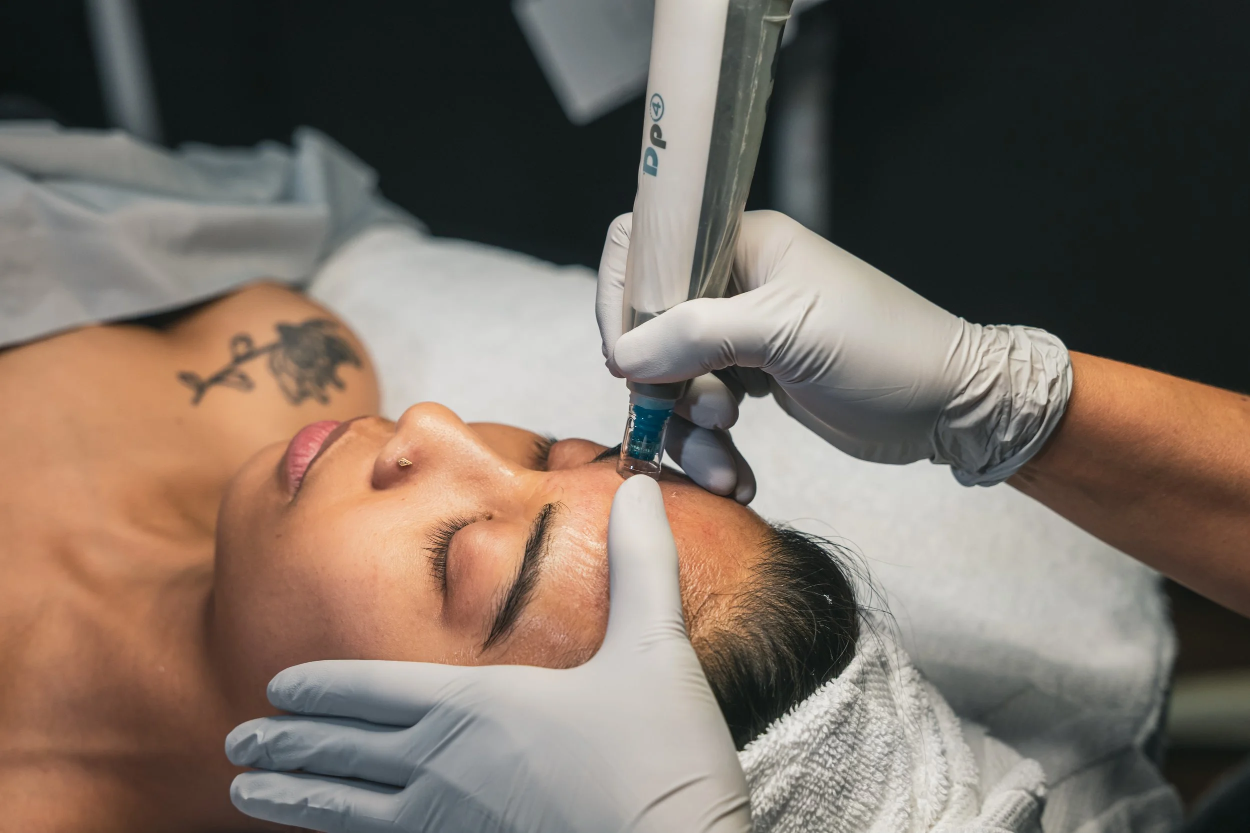 Microneedling