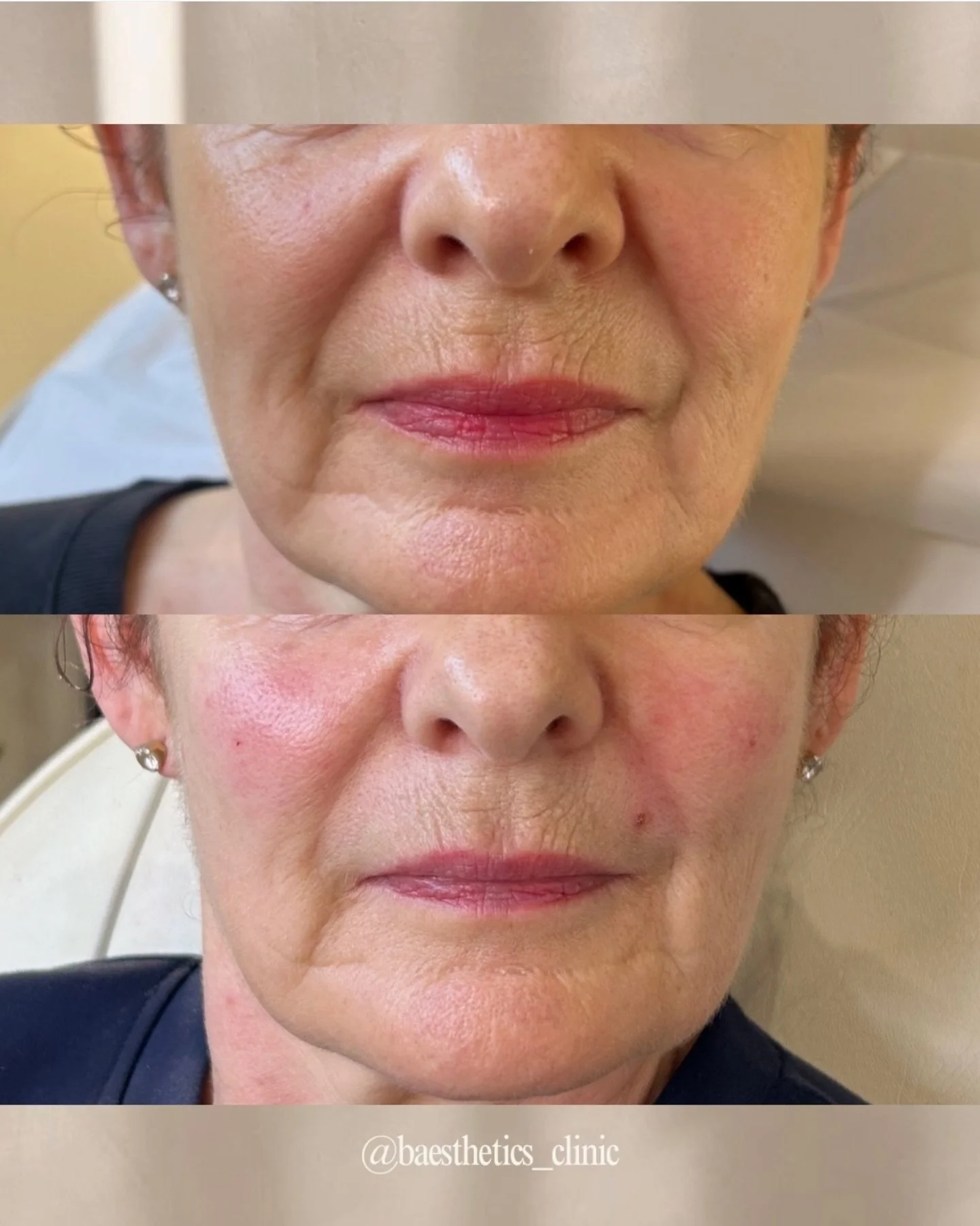 Naturally softening the nasolabial folds with a small tweak to the medial fat pads to support 💉 

Surprisingly, having fat (or the appearance of fat) in the mid-face, is what helps us to appear younger. We naturally lose fat in these areas as we age