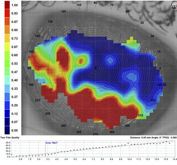 NIBUT non-invasive tear breakup time measurement showing tear film stability