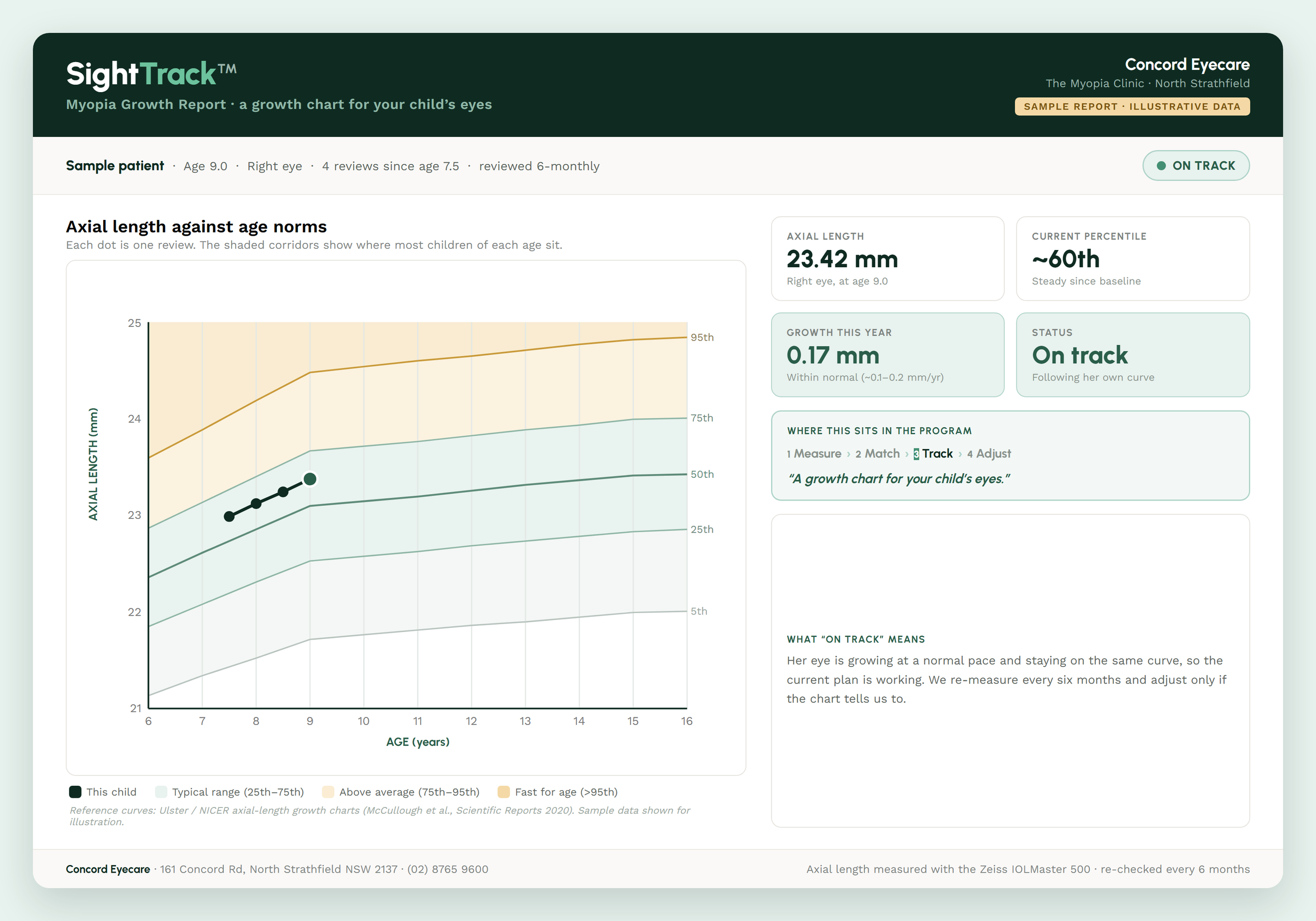 What is axial length — and why we treat it like a growth chart for your child’s eyes
