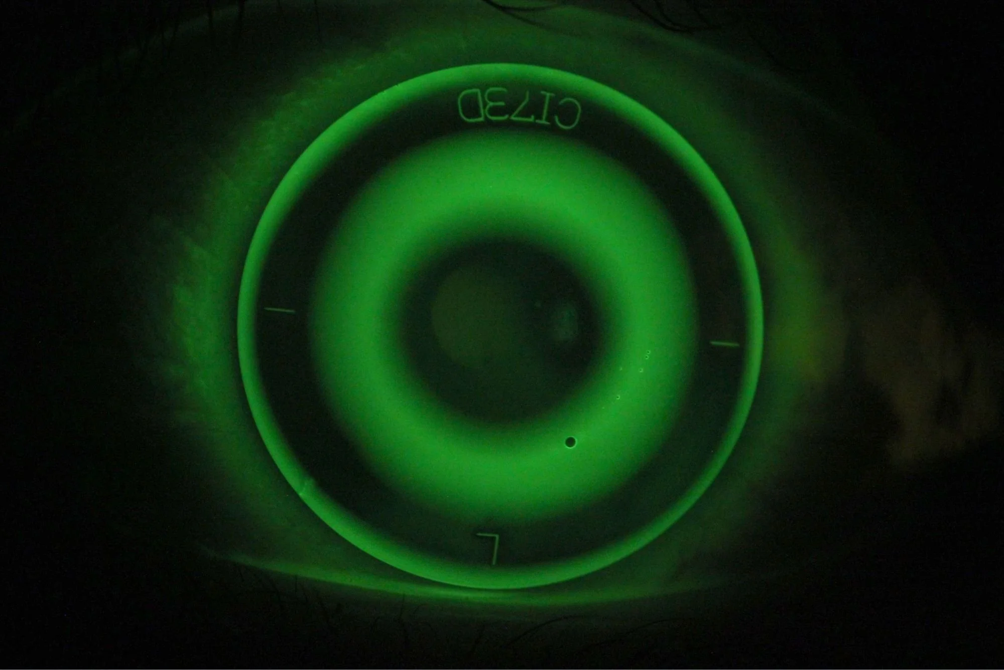 Close-up of a orthok lens on eye, fluoroscein pattern