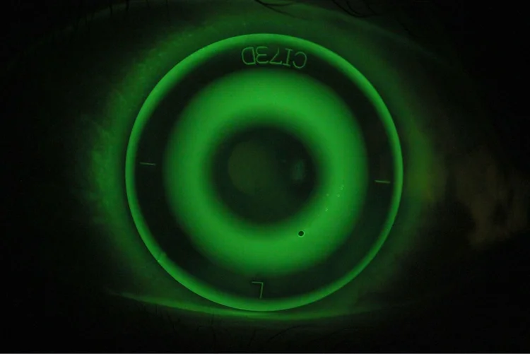 Ortho-K contact lens fitting at Concord Eyecare myopia clinic