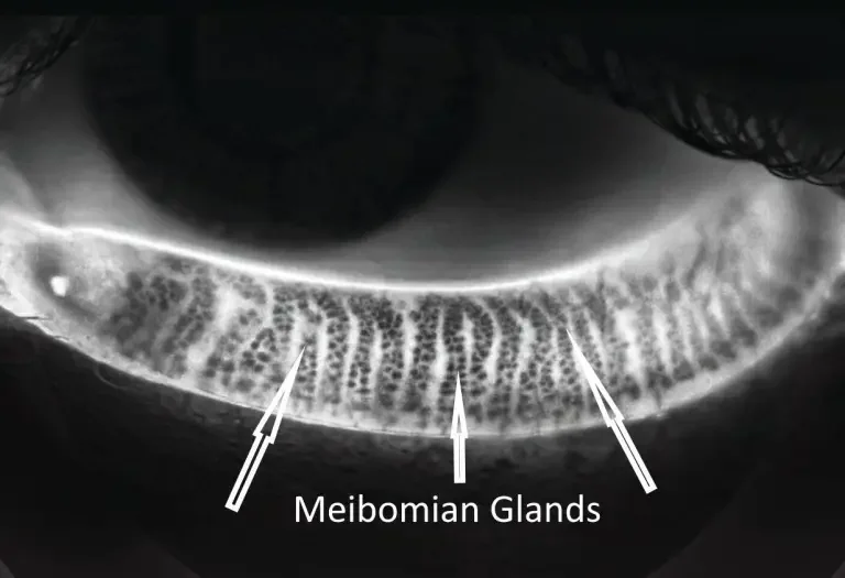 Meibography infrared imaging showing meibomian gland structure